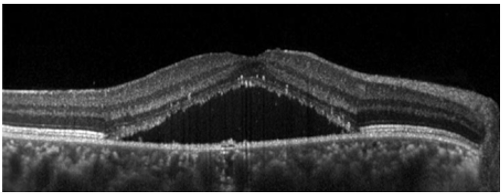 Central Serous Chorioretinopathy (CSCR) — AM EYES - Toronto Eye Care Clinic