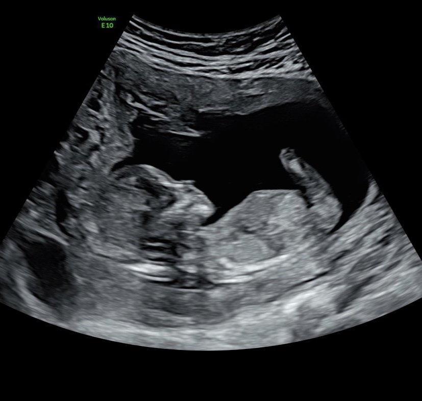Baby Dupont: First Trimester 