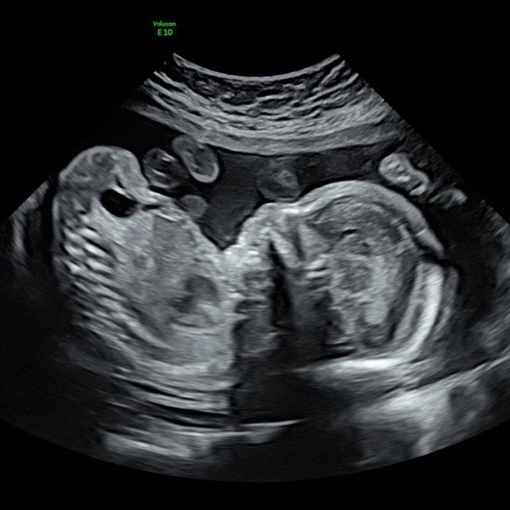 Baby Dupont: Second Trimester