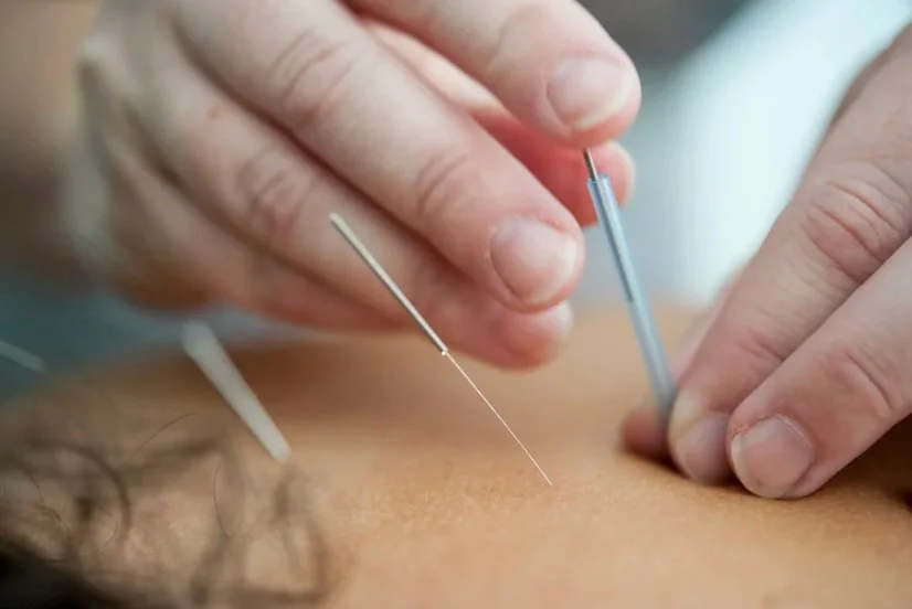 acupuncturist inserting needles into a patient's back