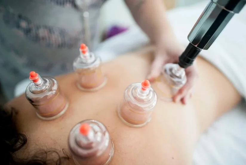 Plastic cups being applied to a woman's back