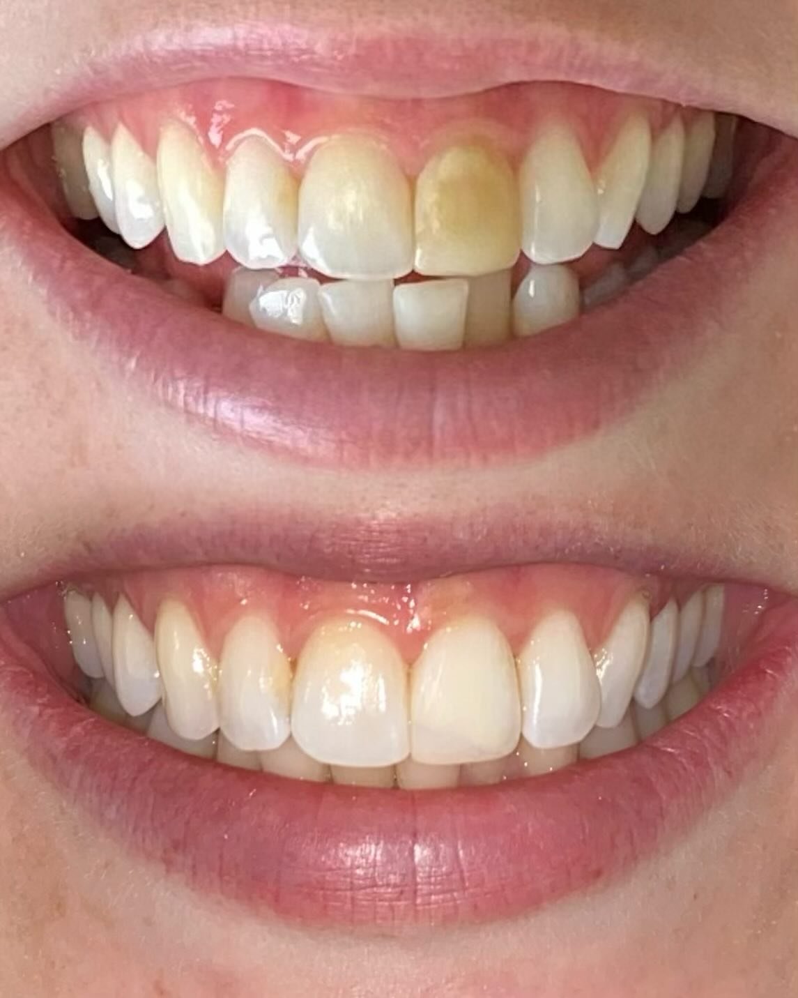 Patient presents with discolored front tooth due to historical trauma. The tooth is asymptomatic and the radiograph revealed calcific metamorphosis (nerve and blood vessels completely calcified) with a normal apex (no infections), and thus there was 