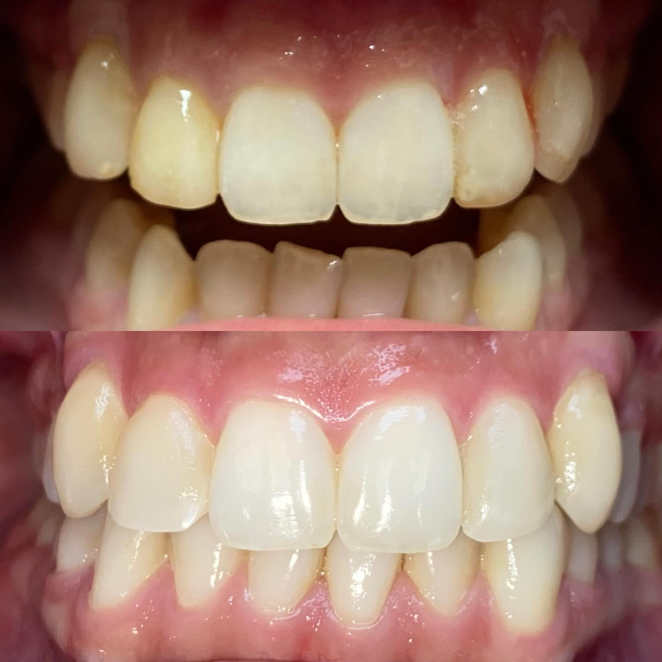 Old resin veneers #6, 7, 10, 11 that are matted and staining with bulky contours. After some bleaching, we removed the old bonded resin and layered the new resin veneers free handed. It&rsquo;s not my favorite cosmetic approach, as I love porcelain t