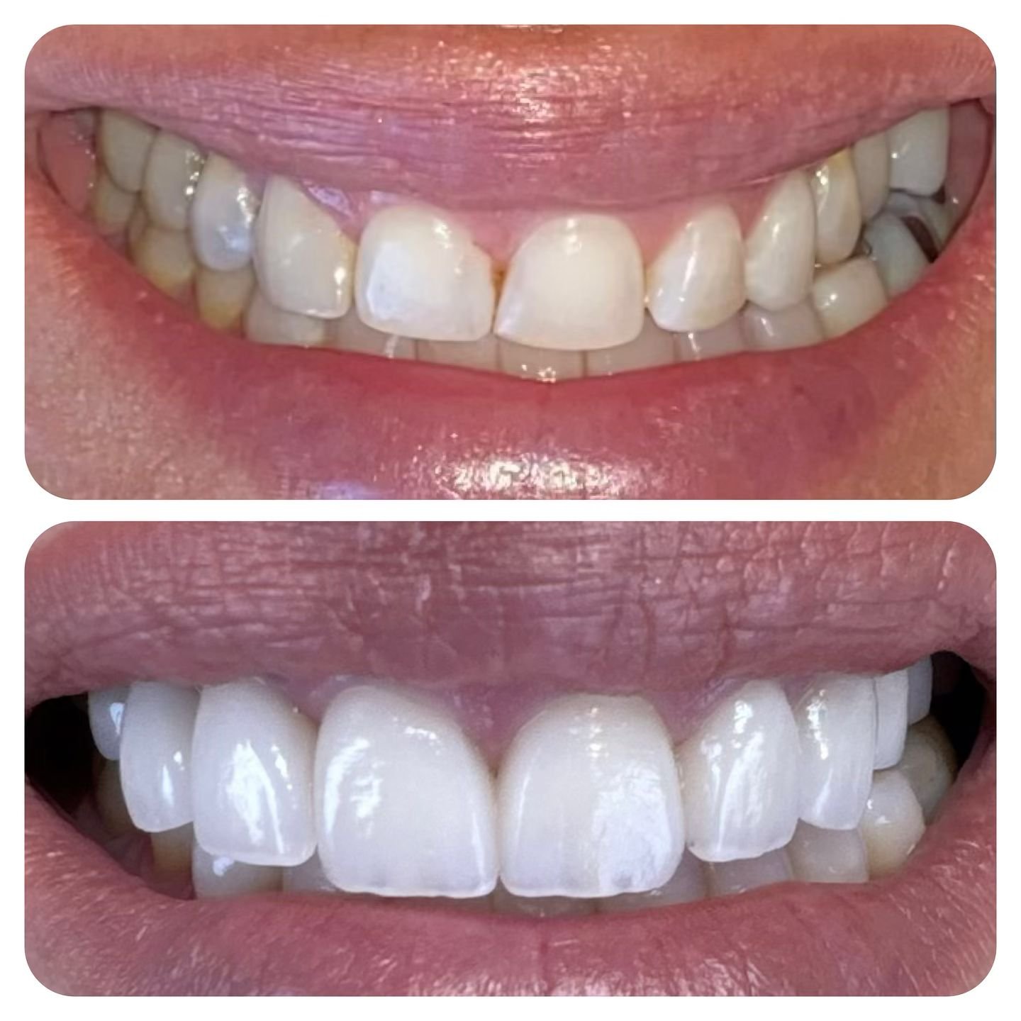 Sometimes we get to make drastic changes in people&rsquo;s smiles. It doesn&rsquo;t get much more romantic than that in dentistry.

For my dental nerds: Our patient wanted straighter, longer, and whiter teeth. We also noticed a narrow maxilla with a 