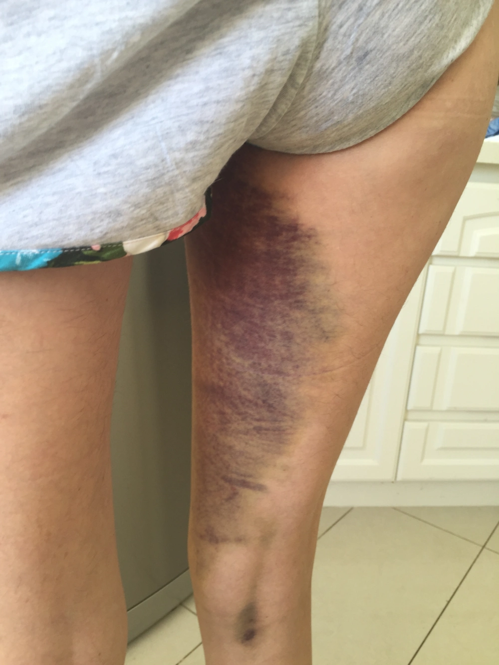 bruise copy 3.png