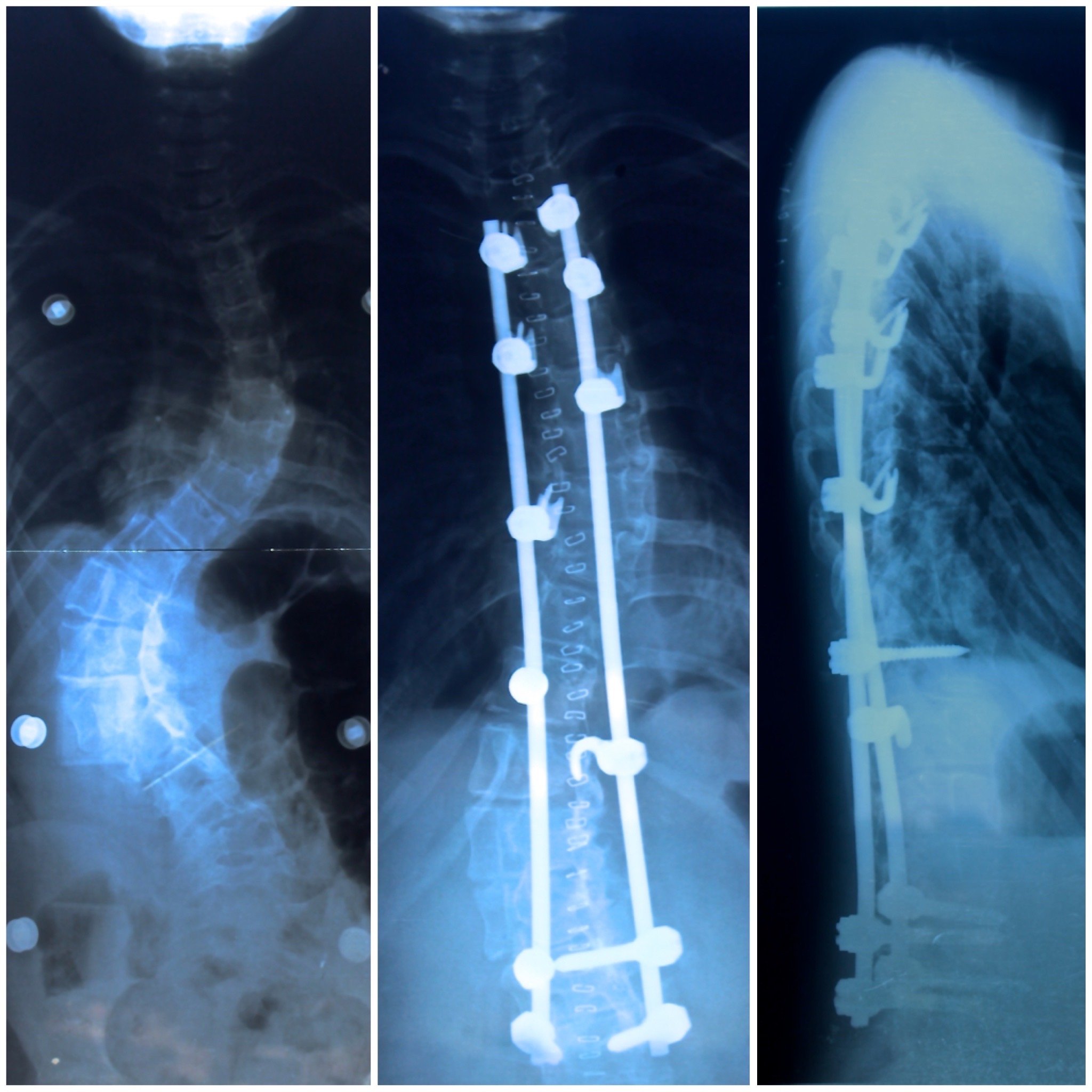Sian 9 years old xrays pre and post surgery .JPG