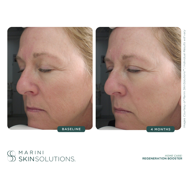 Side-by-side comparison of a woman's face before and four months after a skincare treatment, showing reduced wrinkles and improved skin texture.