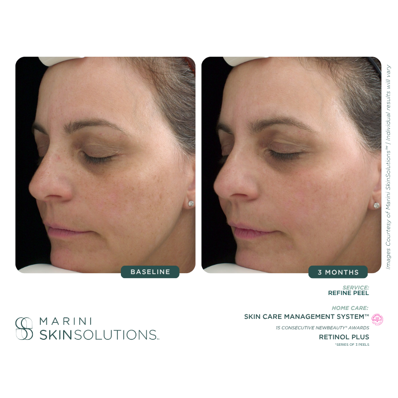 Comparison of a woman's face, showing skin improvement over 3 months. Left image is baseline, right image is after 3 months.