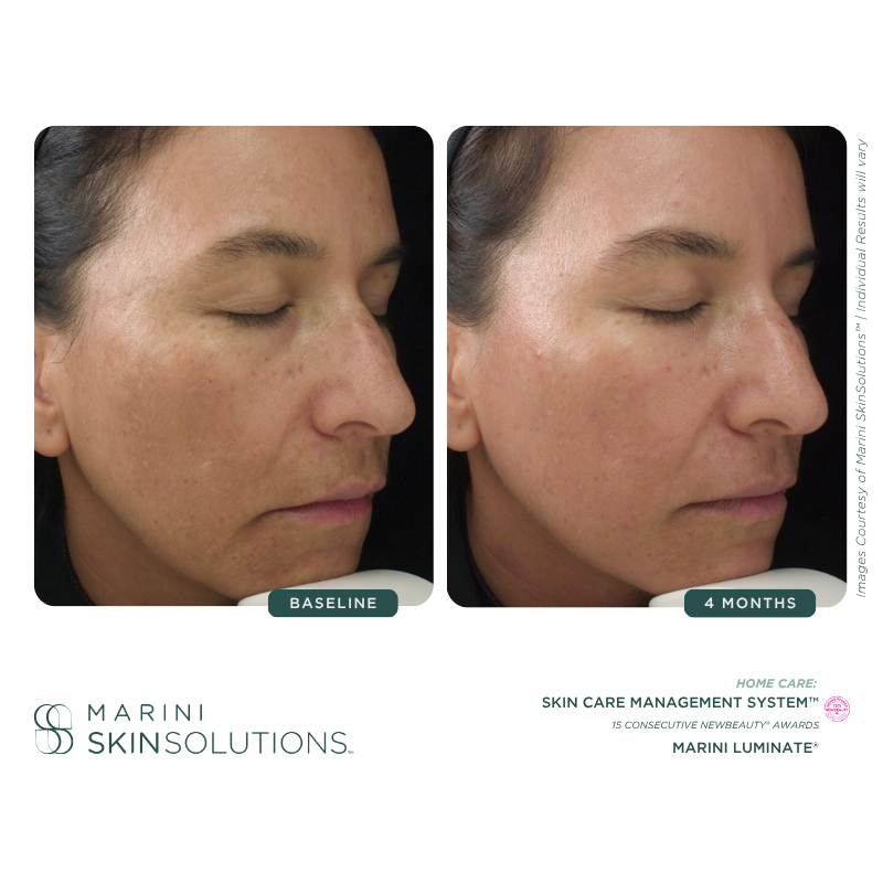 Side-by-side comparison of a woman's face before and after skincare treatment, showing improved skin texture and clarity after four months.
