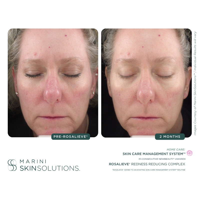 Comparison of a woman's face before and after 2 months of using a skincare product, showing improved skin texture and reduced redness.