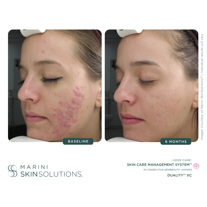 Side-by-side comparison of a woman's face showing severe acne at the baseline and clear skin after 6 months of treatment.