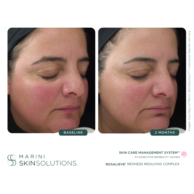Side-by-side comparison of a woman's face showing a reduction in redness and skin blemishes after two months of skincare treatment, with labels indicating 'Baseline' and '2 Months'.