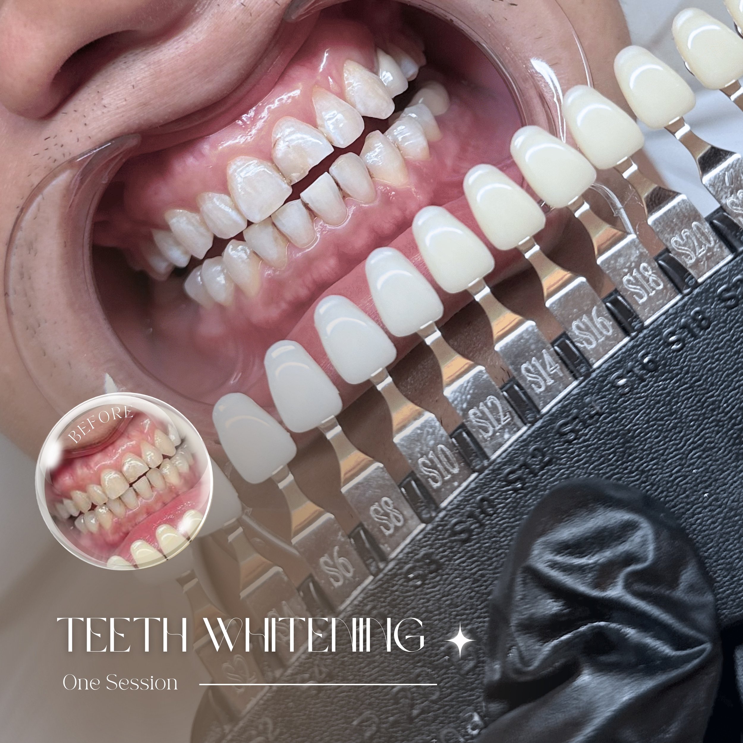 Real people, real results! 😬 Get your teeth whitened with 8 to 12 shades lighter in just 1 session! The LED light from our device greatly accelerates and enhances whitening results and reduces the side effects from whitening process. Enjoy now the n