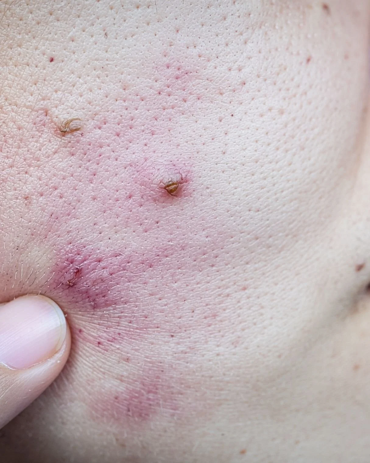 Close-up of human skin with pimples and blemishes, with a person pressing on another blemish near the corner of their mouth.