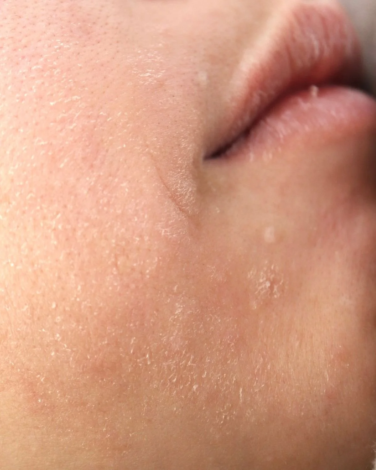 Close-up of a person's cheek with visible dry skin and fine hair, near the corner of their mouth.