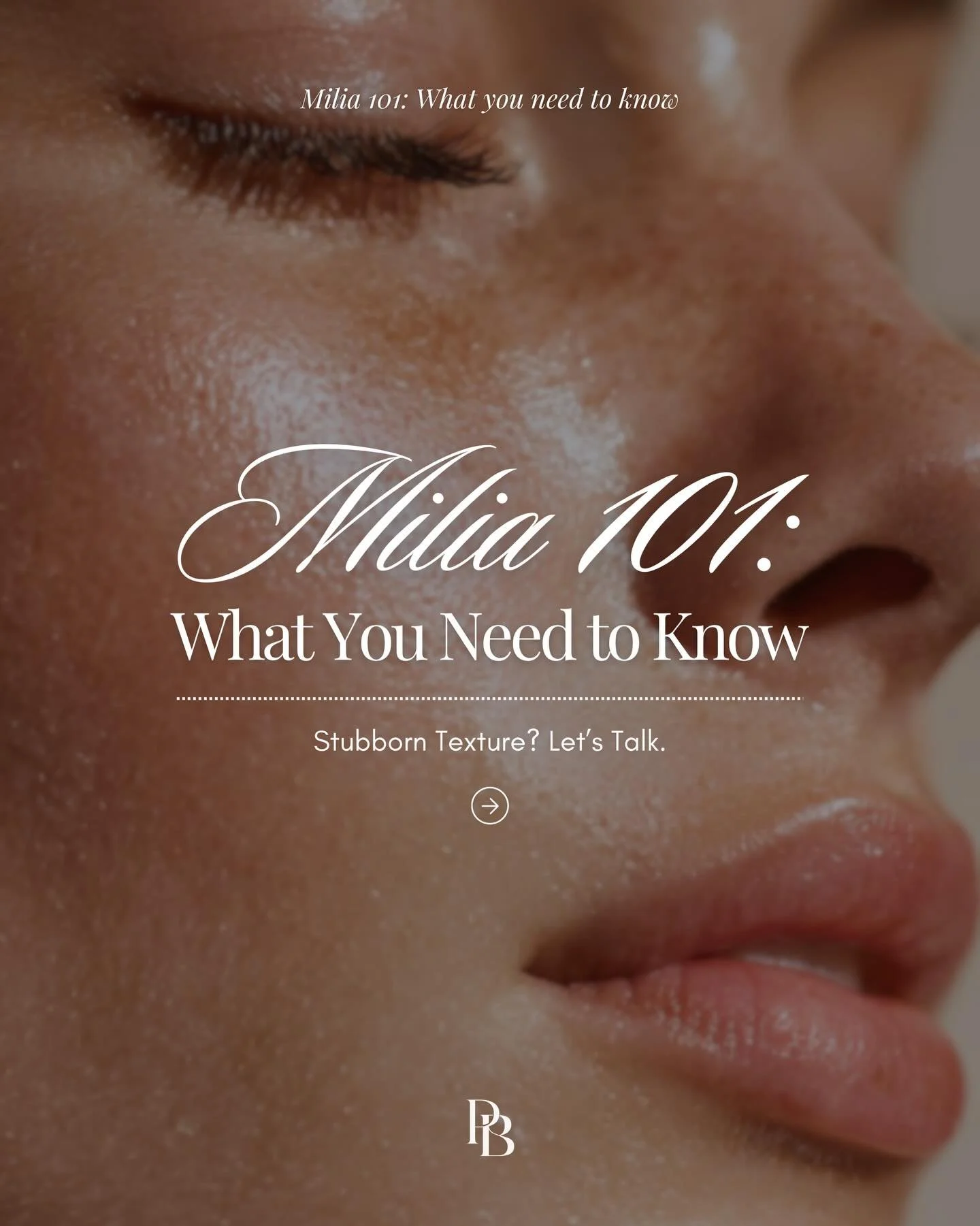 Those tiny white bumps that just won&rsquo;t go away? It might be milia. 🤔

Swipe through to learn what causes milia and how they can be treated safely. If stubborn texture has been bothering you, our milia treatment at Pocobeauty is designed to gen