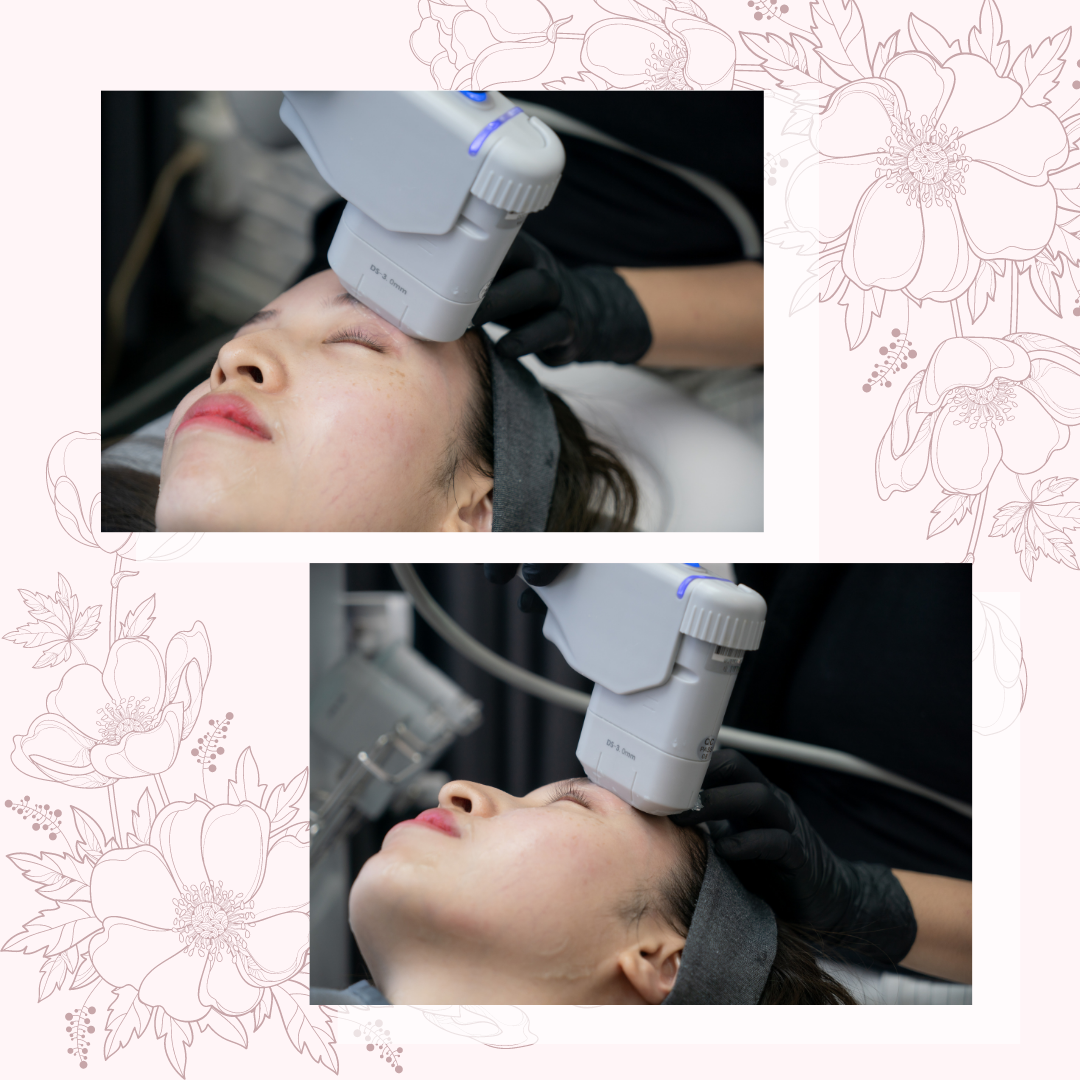 pocobeauty hifu treatment