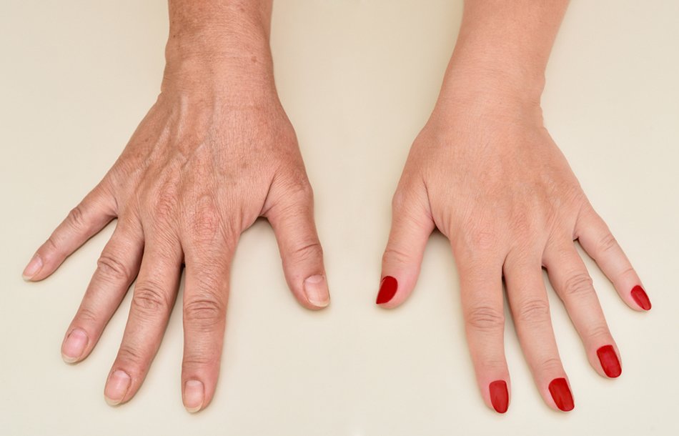 before and after hand rejuvenation