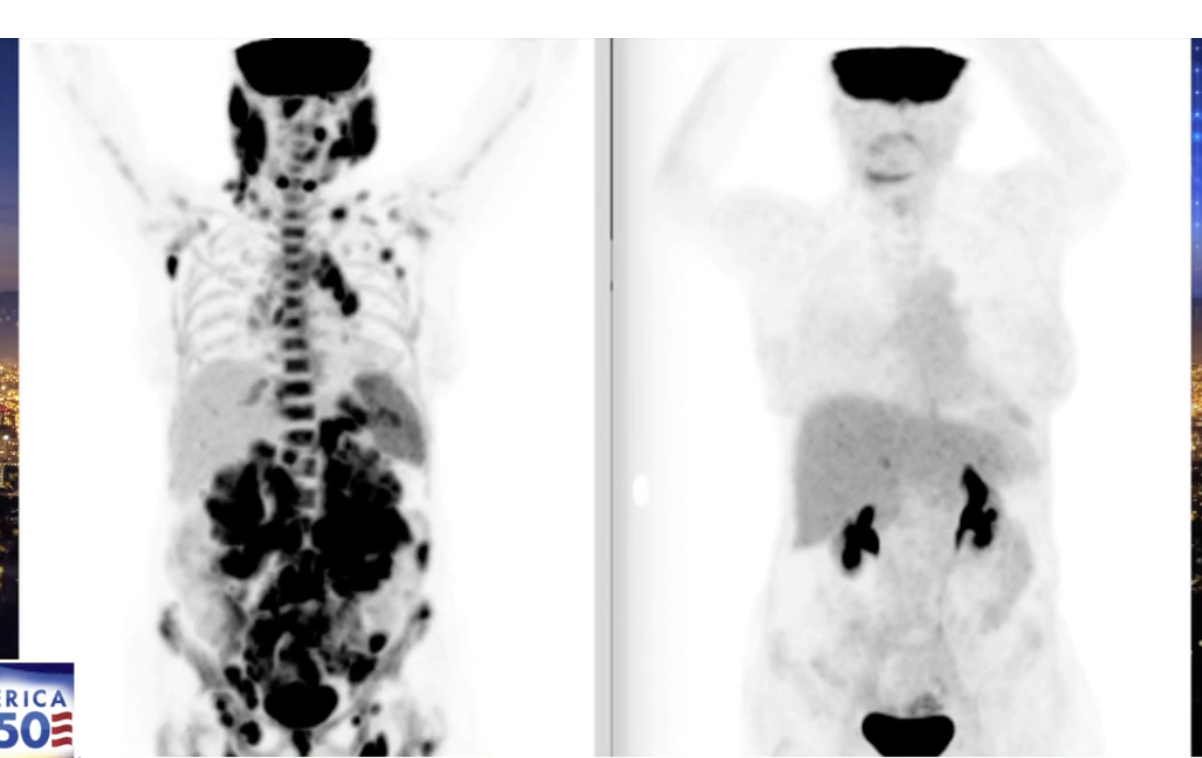 Before and after Car-T treatment