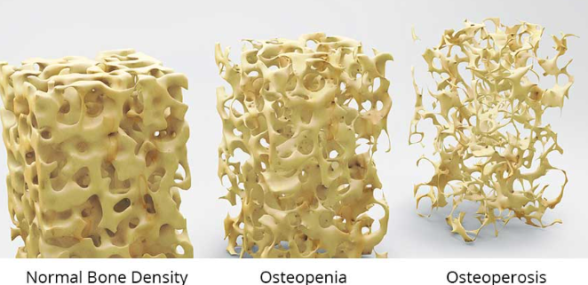 osteoporosis image .png