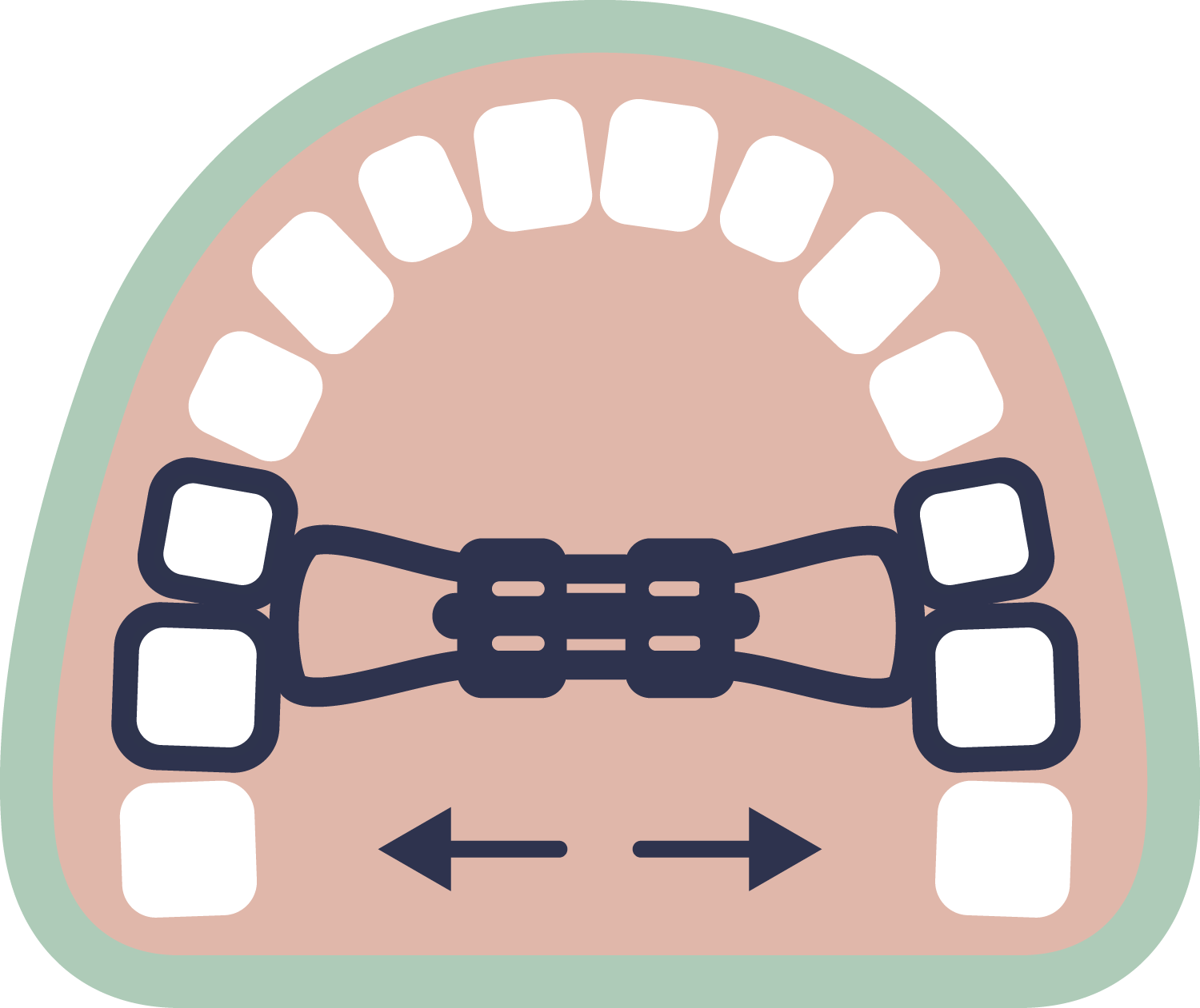 Diagram of a palatal expander and teeth, with arrows indicating the adjustment direction.