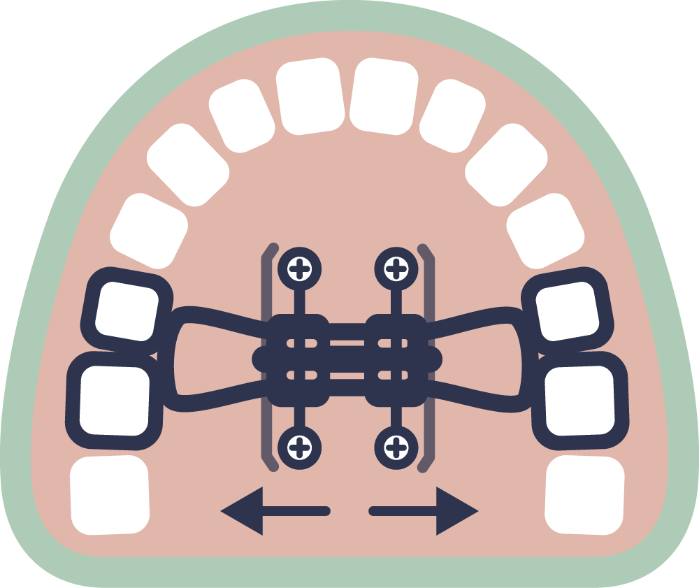 Diagram of a MARPE palatal expander and teeth, with arrows indicating the adjustment direction.
