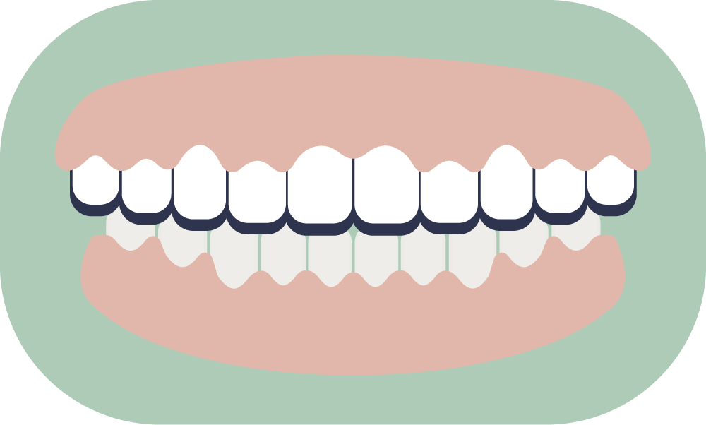 Illustration of human teeth in an open mouth, showing both upper and lower sets of teeth.