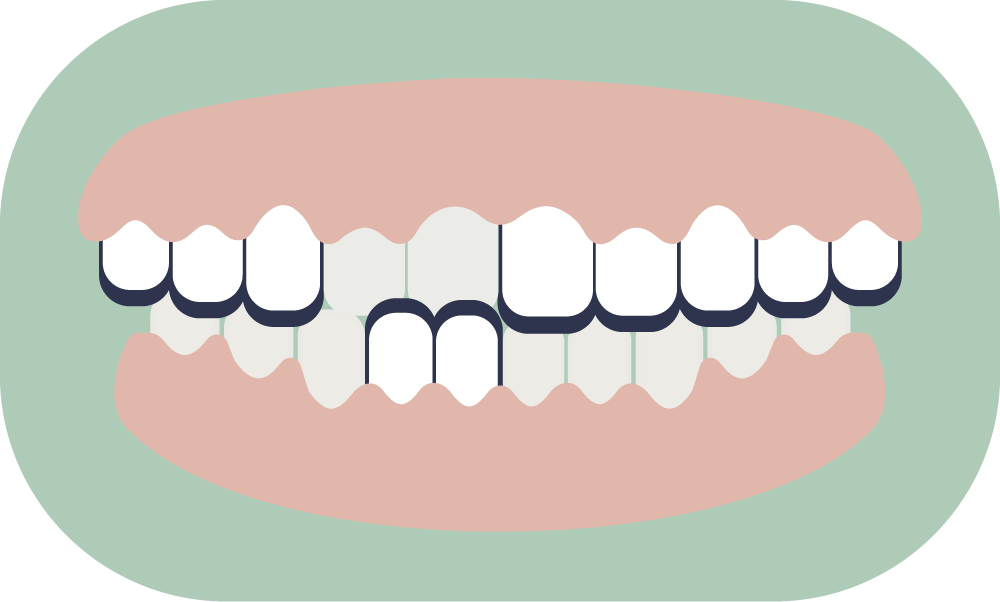 Illustration of a mouth with teeth, gums, and lips, in a cartoon style.