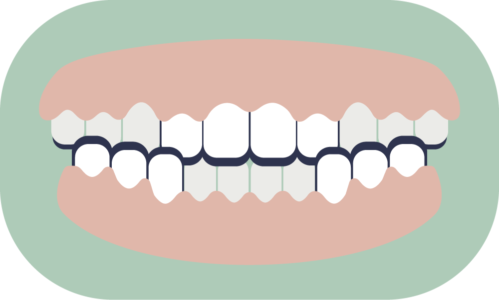 Illustration of an open mouth showing teeth and gums.