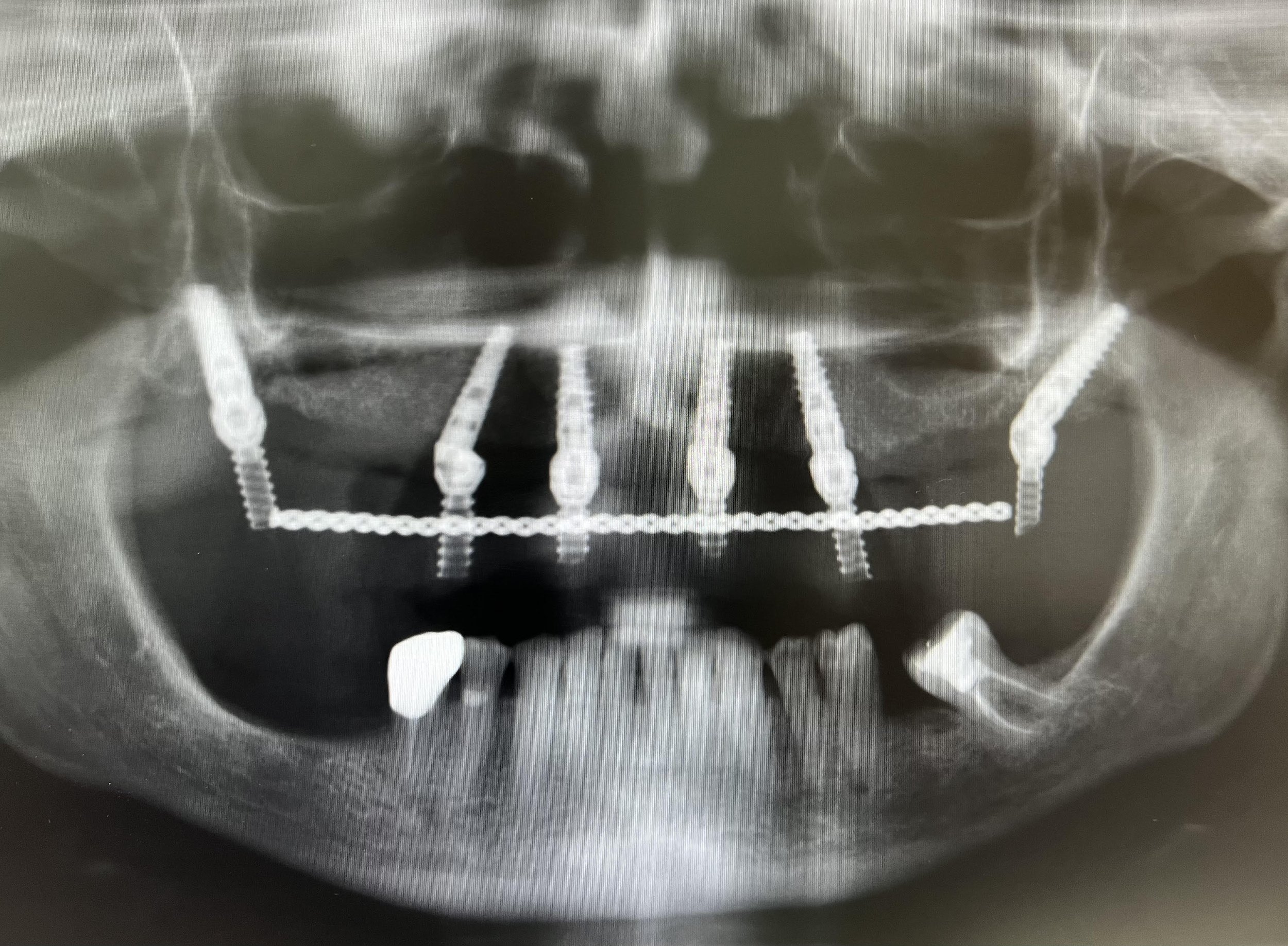 HILL ORAL SURGERY