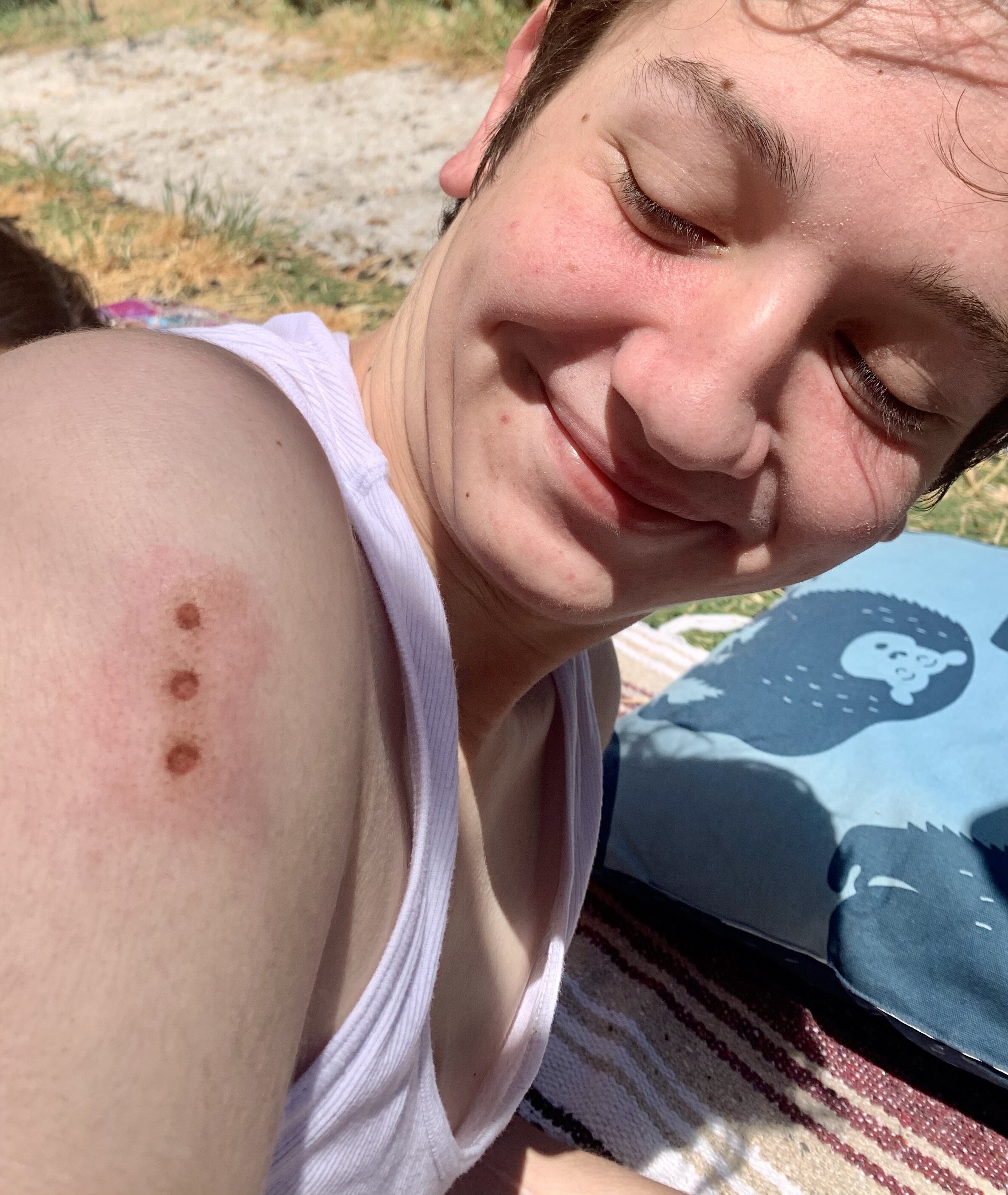 Some say its a badge of honor or being "Kissed by the Frog". Its almost as if your embodying the Kambo frog spirit. 