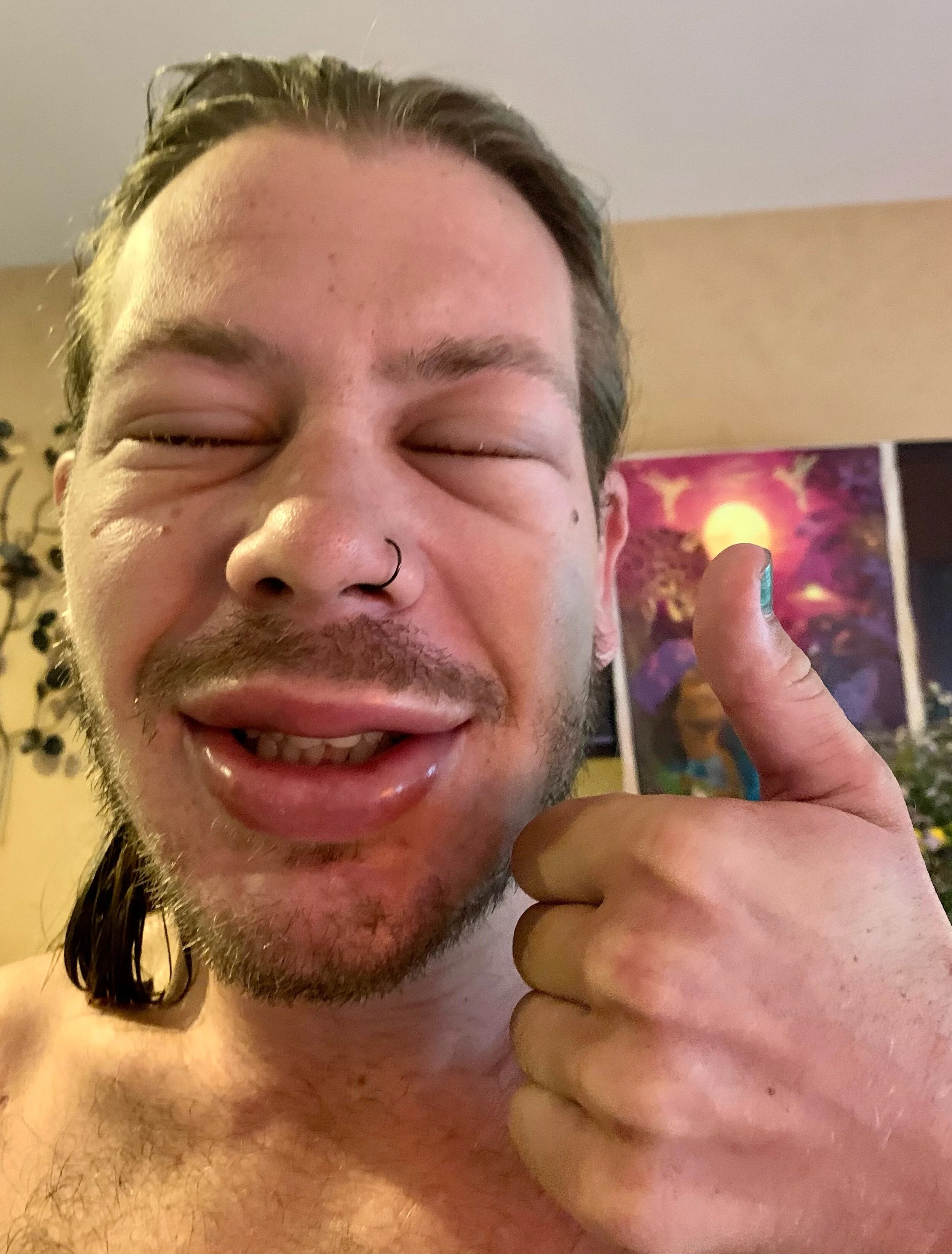 Frog face is a side effect of the Kambo medicine that subsides a couple of hours after ceremony or slight puffiness may linger until the next day. 