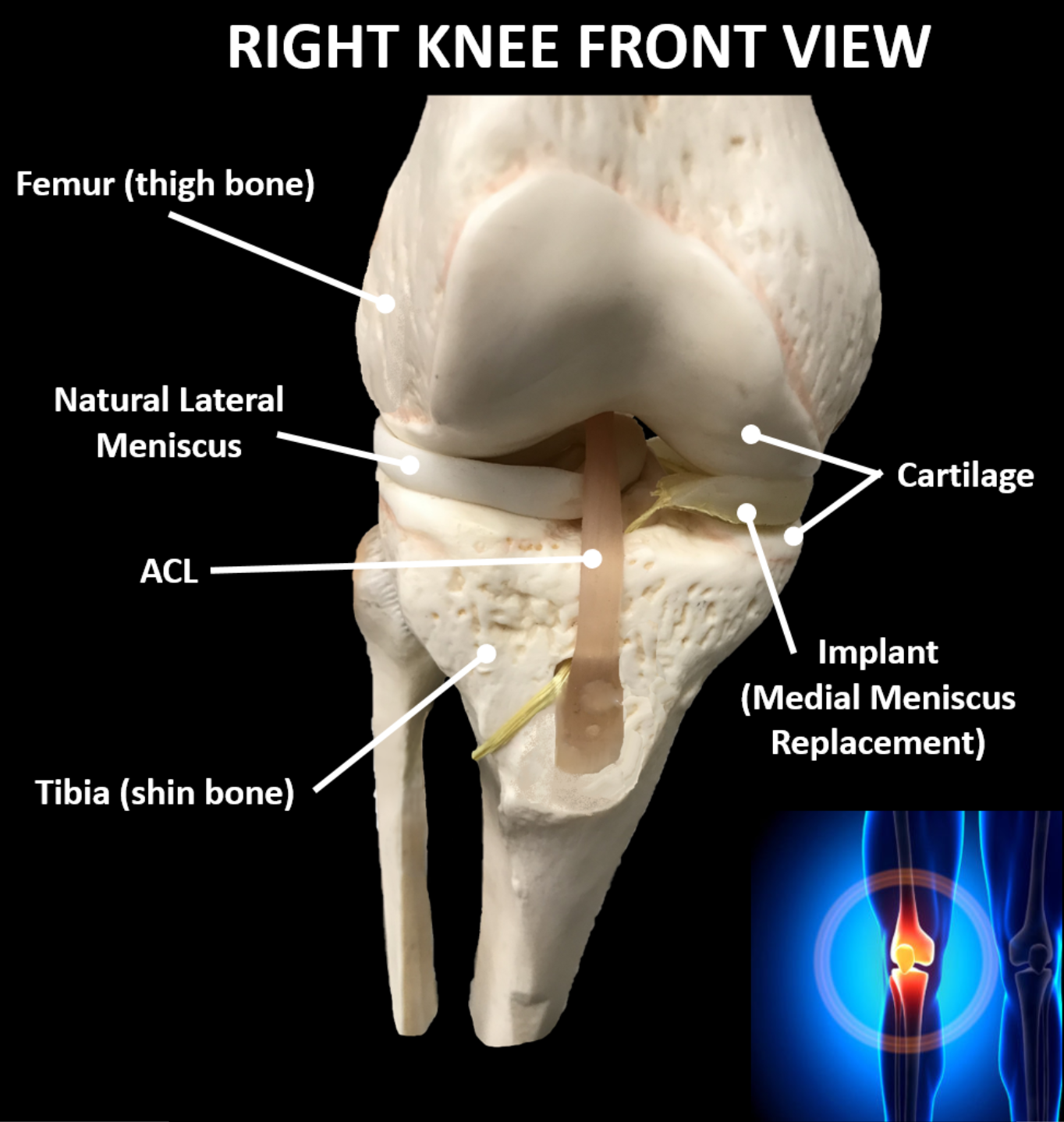 Meniscus Replacement — OrthoPreserve Meniscus Implant for Knee Pain