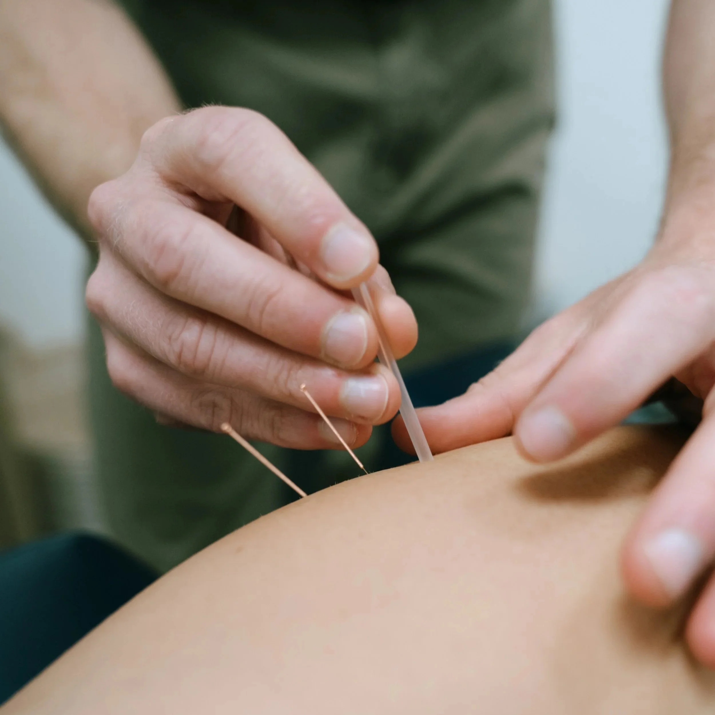 Acupuncture muscle pain trigger point needling