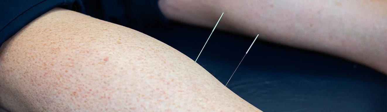 How Does Dry Needling Work?
