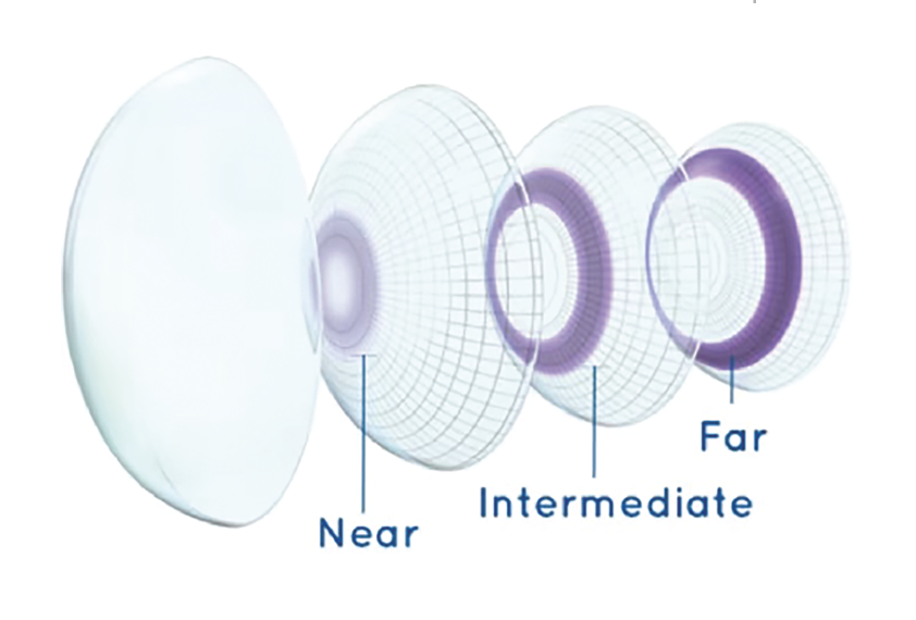 What Are Multifocal Contact Lenses—and Are They Right for You?