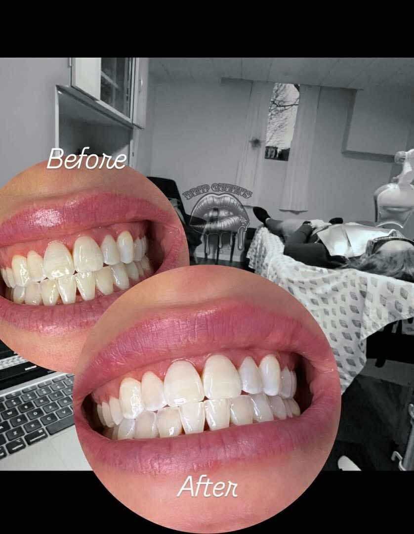 The best teeth whitening is here with Drip Queens.