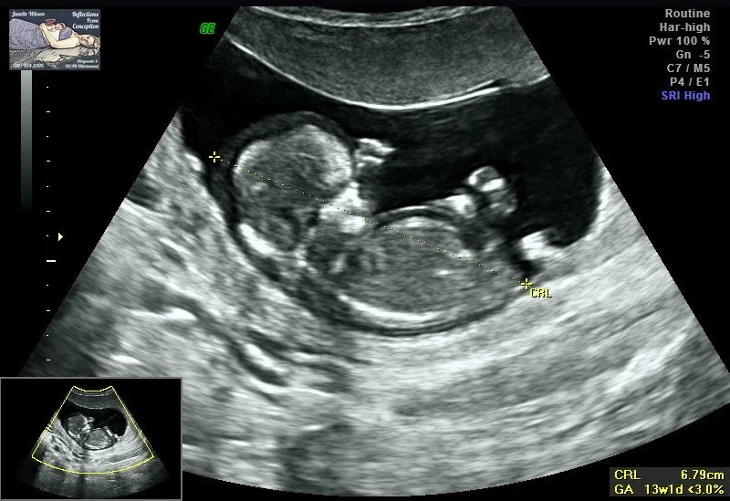 The Miscarriage Story of Preston James Gipper