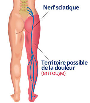 J'ai la sciatique!