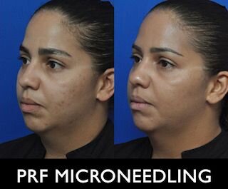 PRF B&A.jpeg