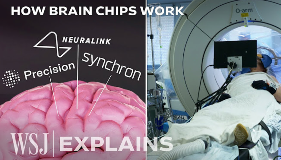 “Neuralink's Rival Tests Brain Chip in Race to Bring Implants to Market”