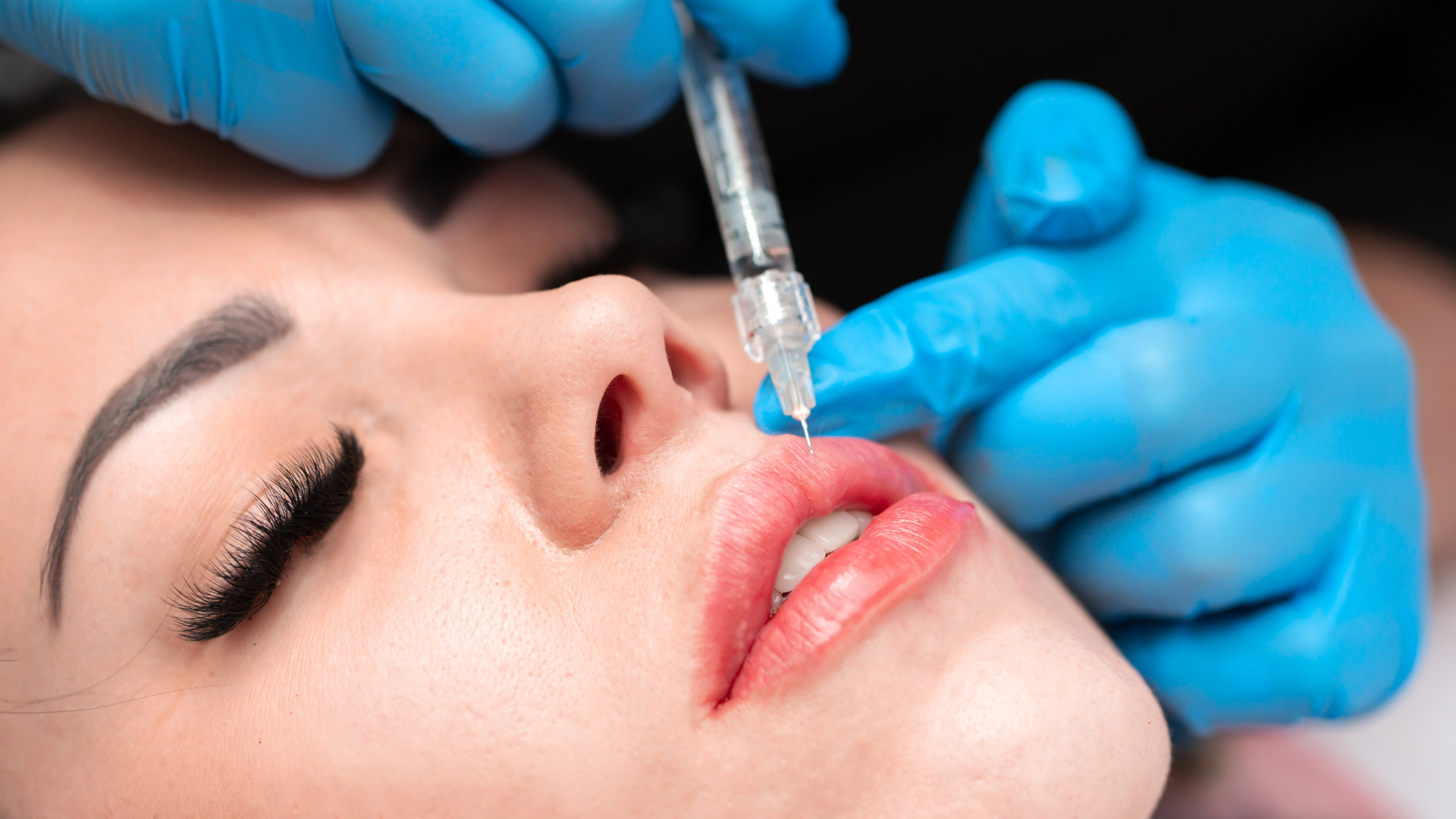 How to Know When It’s Time to Dissolve Your Lip Filler