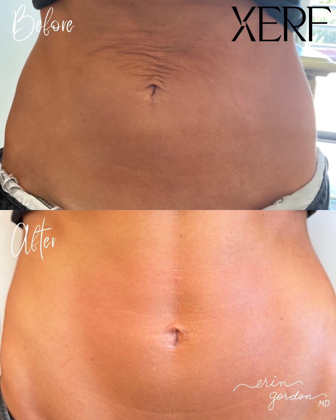 xerf ab results