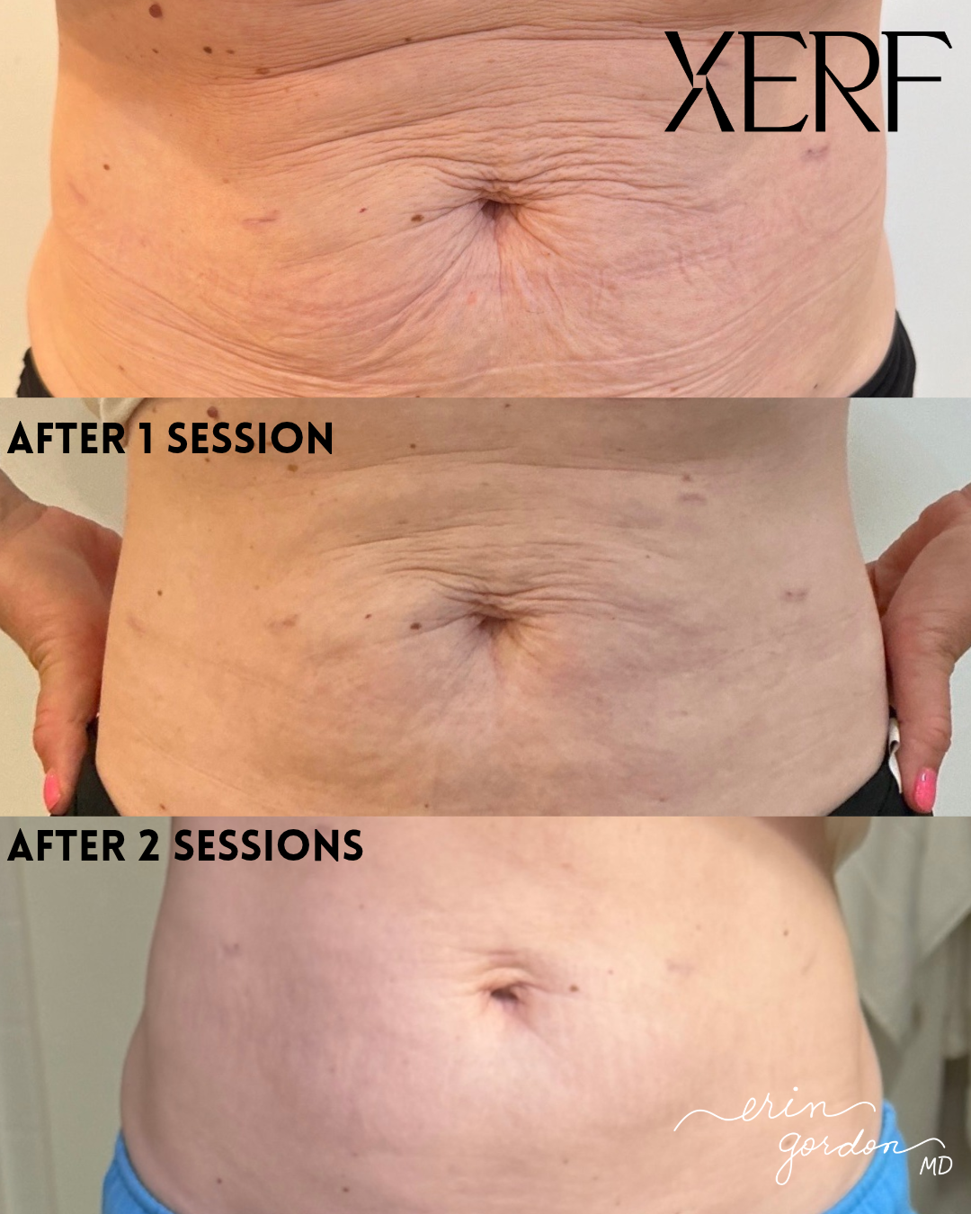 before and after xerf stomach