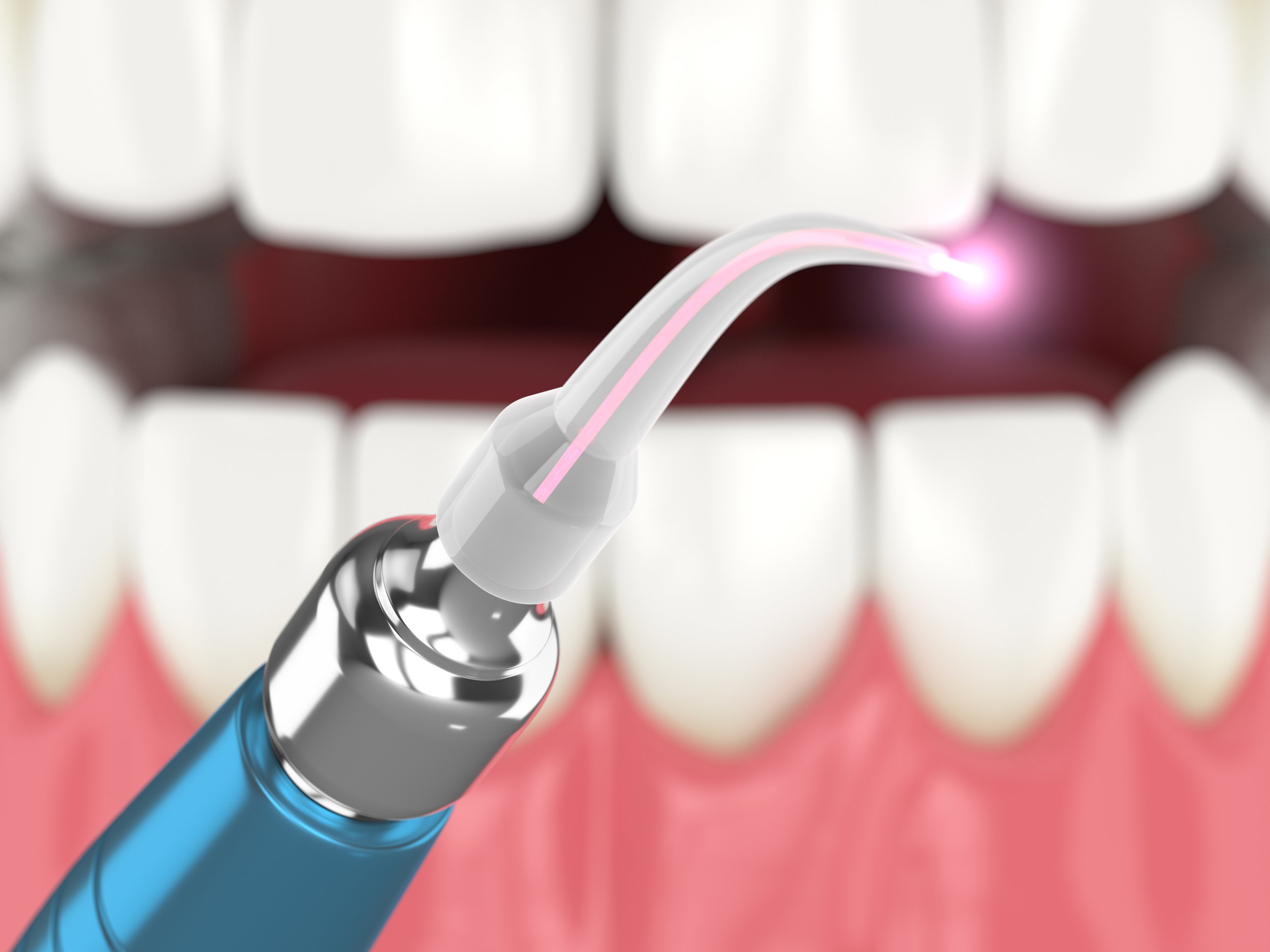 Lasers in Holistic Dentistry: A More Conservative and Less Invasive Approach