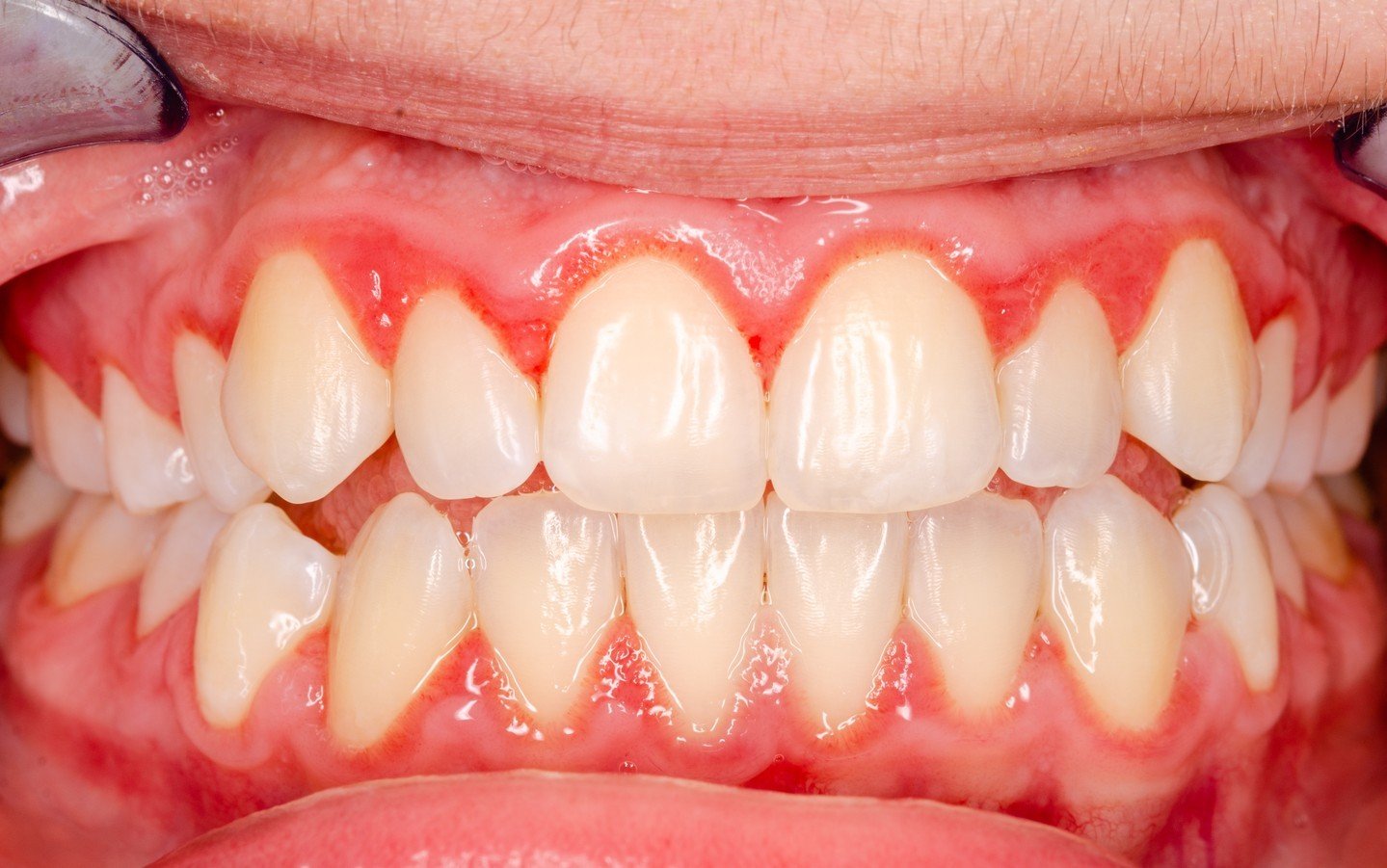 Bleeding gums when you brush? It's not normal! Your body's trying to tell you something about inflammation. Learn what to do about it &ndash; check out our new blog post!

https://loom.ly/Ha6ws3o