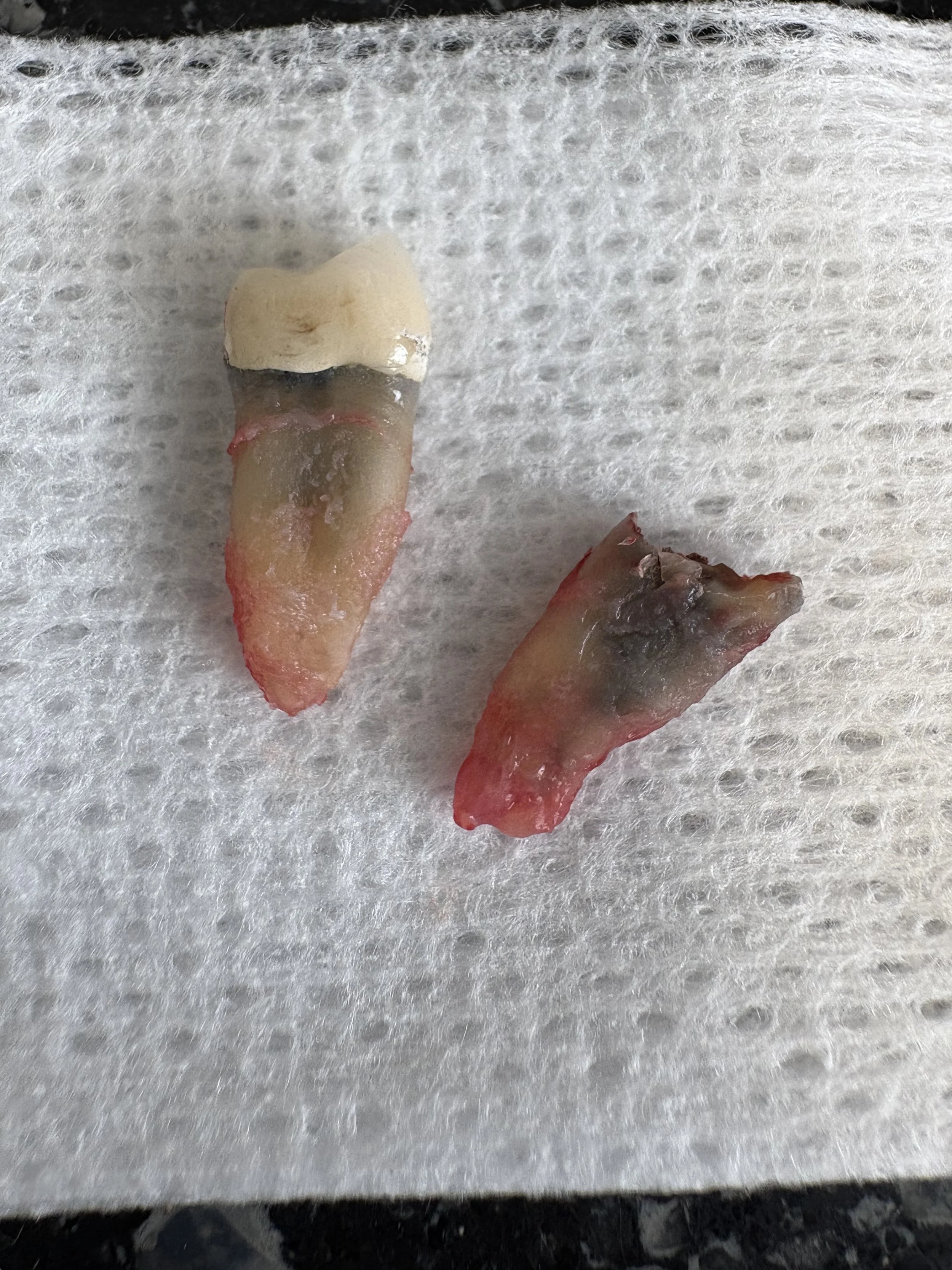 Close-up of a dental extracted tooth with roots on a textured surface.