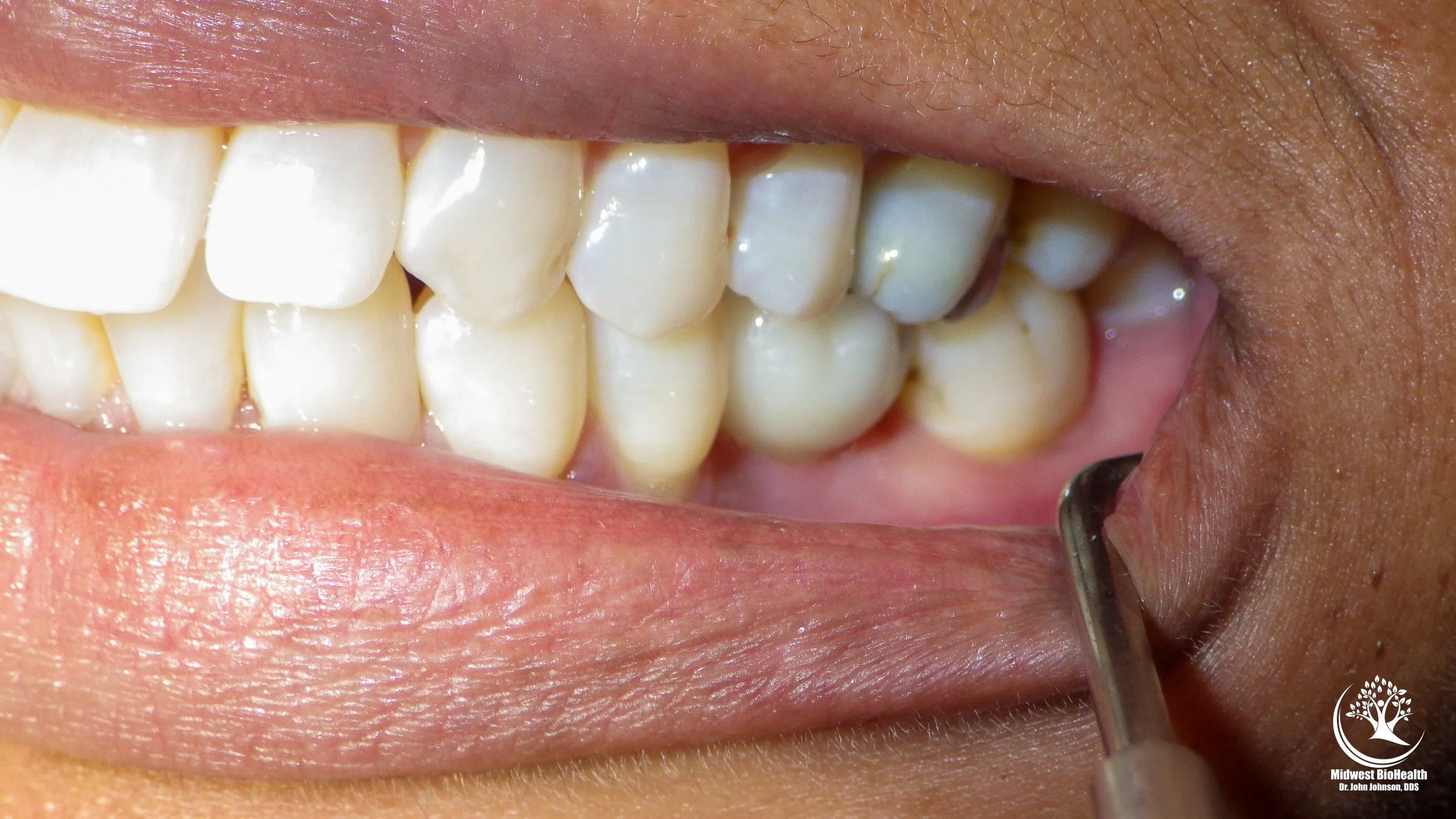 MWBH-ImplantsGallery-13.jpg