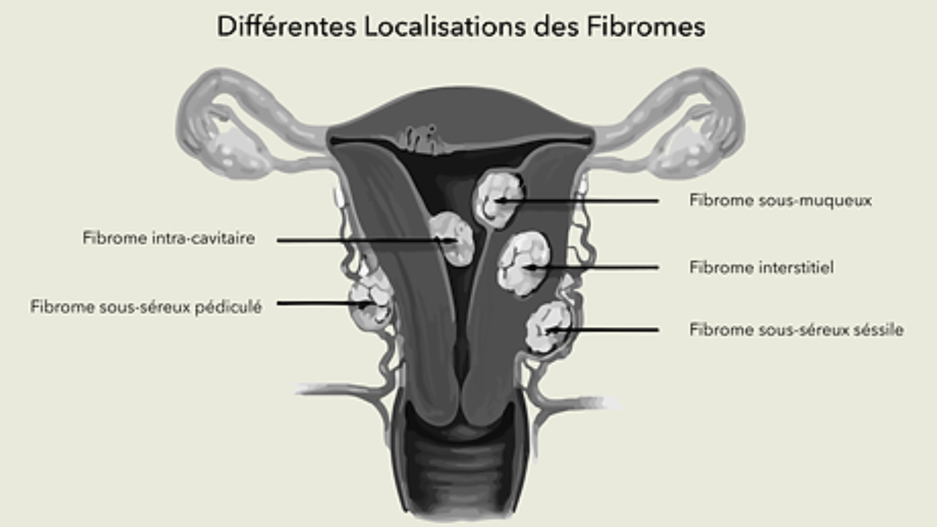 Fibrome utérin — Soins RyMed