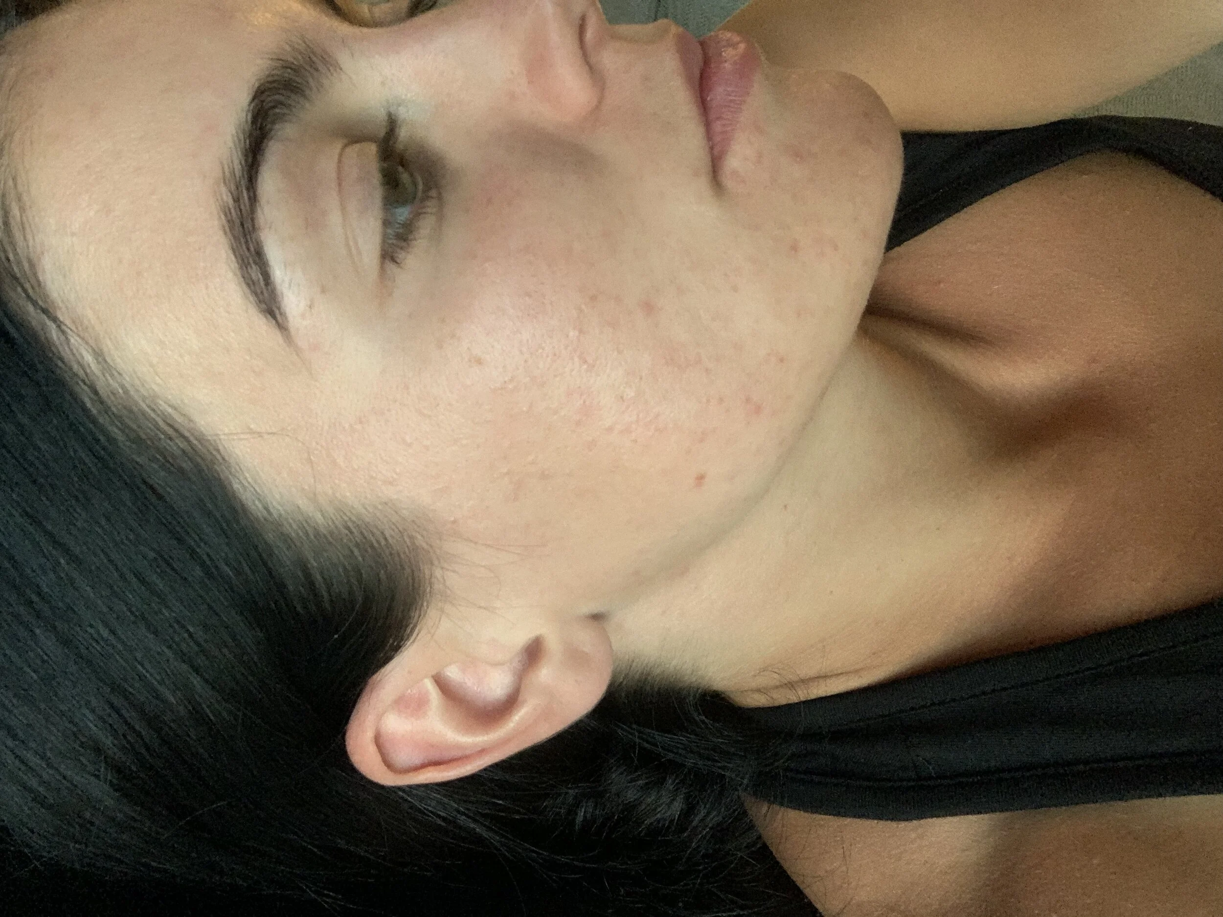 Acne scars after microneedling
